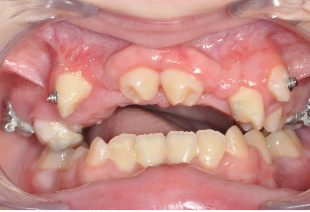 Frontal Intraoral Photo